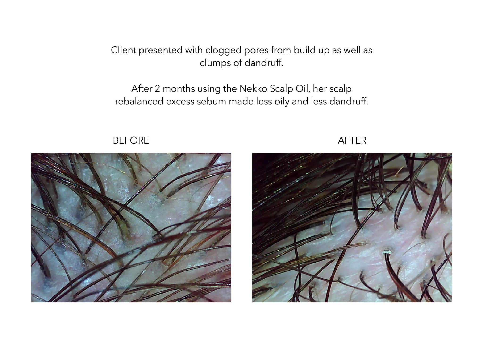 Nekko scalp oil case study before and after